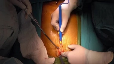 CUANTO CUESTA UNA OPERACIÓN DE CORAZON EN ESTADOS UNIDOS