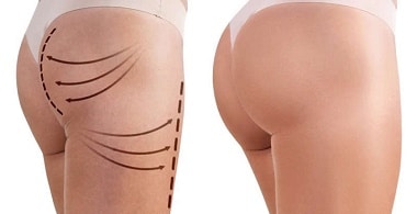 CUANTO CUESTA UNA OPERACIÓN DE GLÚTEOS EN ESTADOS UNIDOS