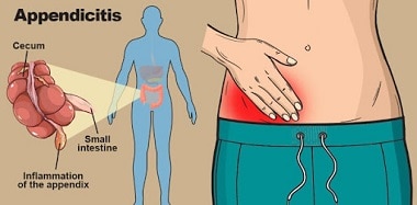 Cuánto cuesta una operación de Apendicitis en Estados Unidos			 			